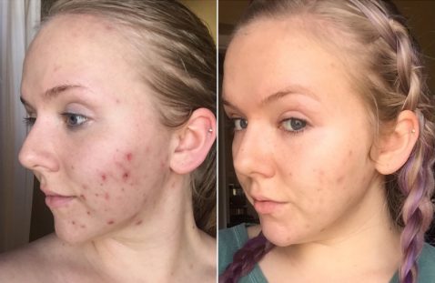 vitamin scars acne oil saviour today scar apply should