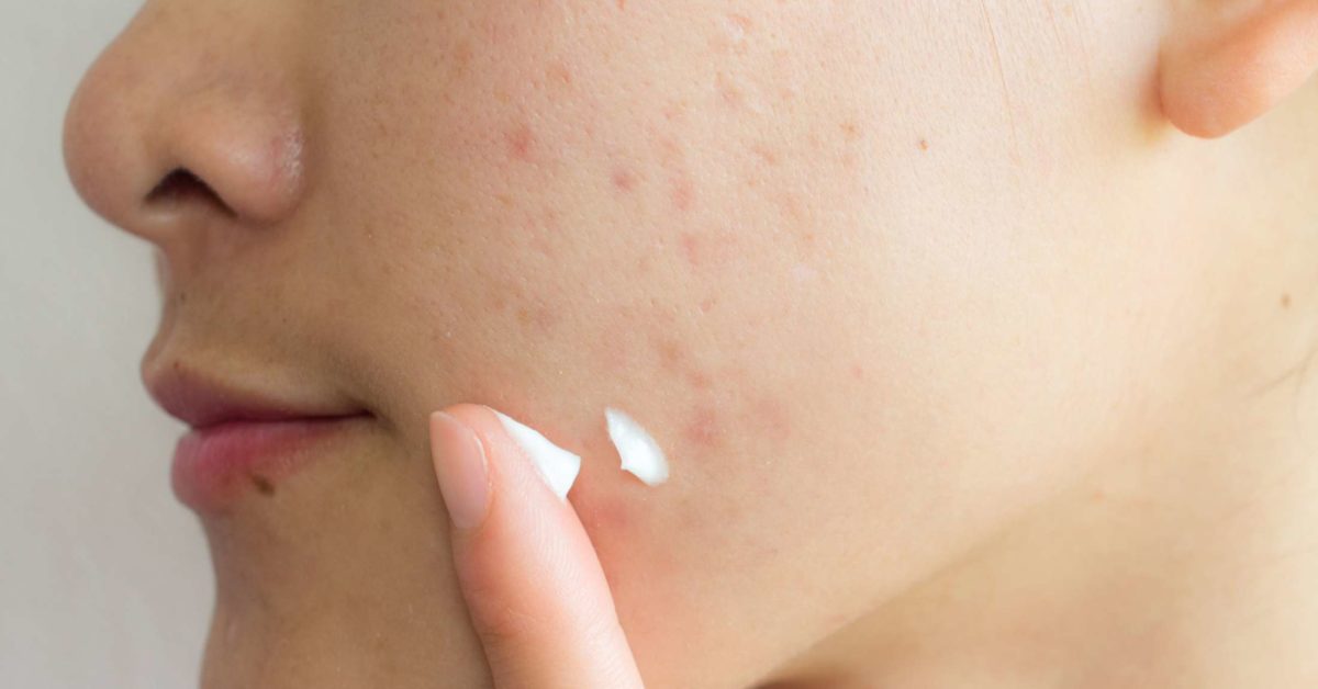 acne marks treatment