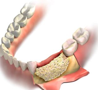 How much Should Bone Grafting do With Teeth Operate?