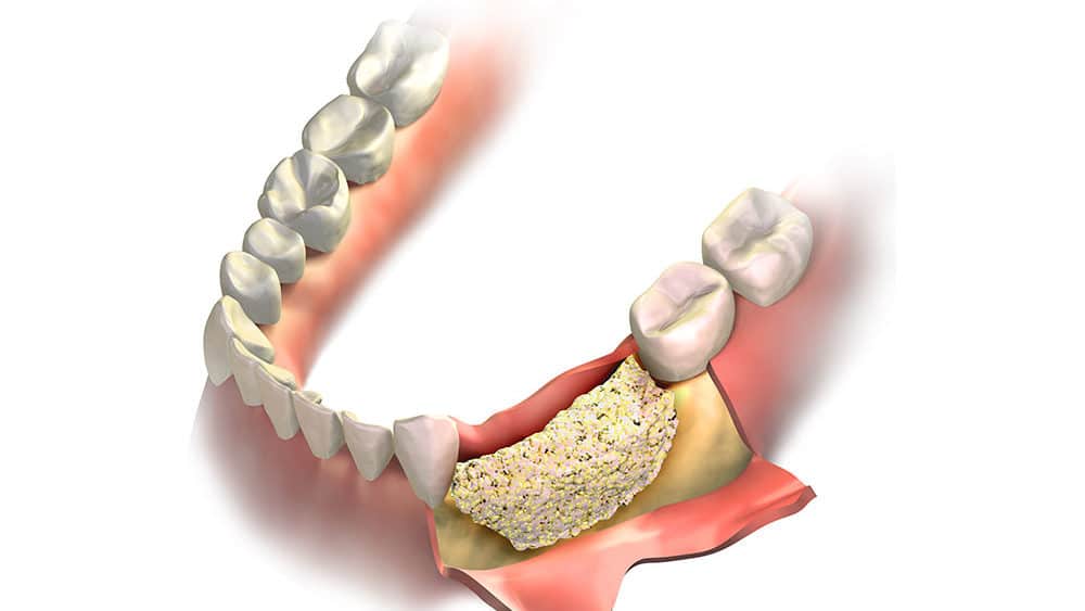 How much Should Bone Grafting do With Teeth Operate?