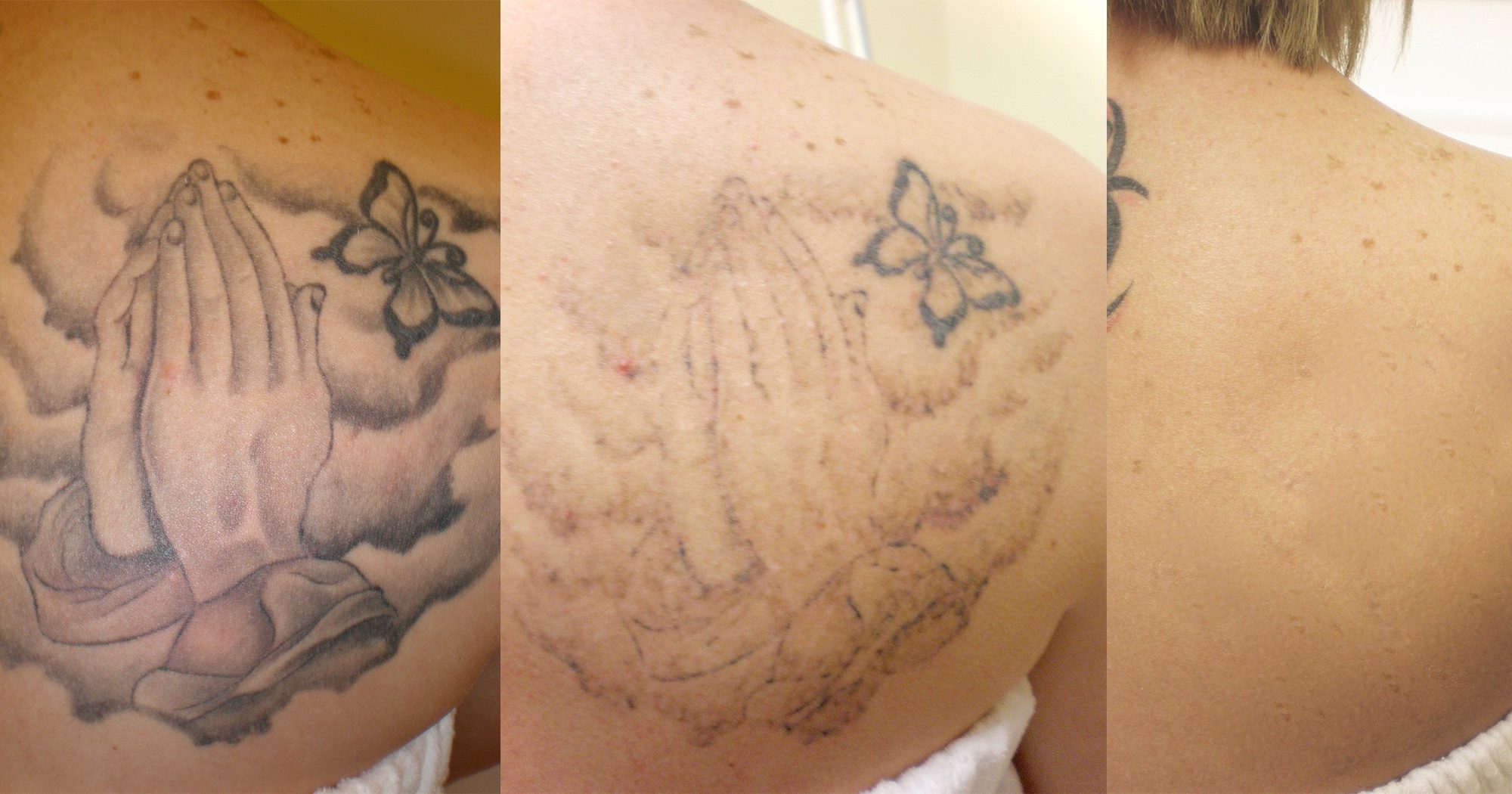 Laser Tatto Removal
