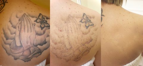 Laser Tatto Removal