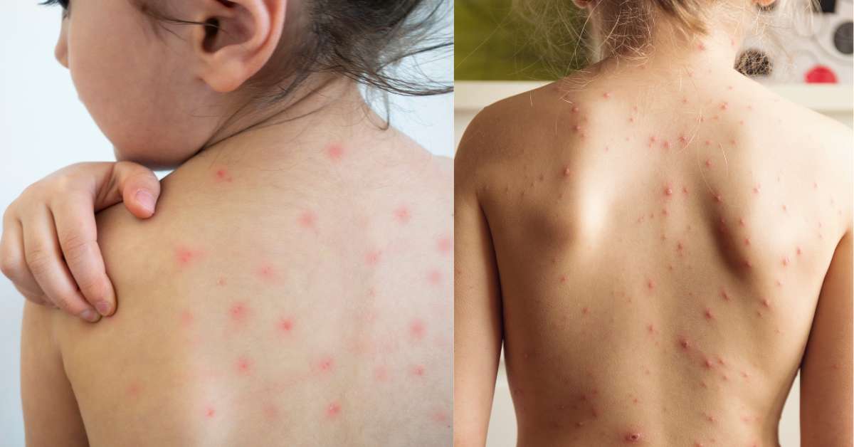 What Are The Causes Of Chickenpox